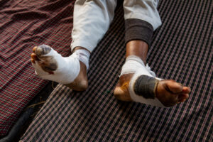 Blistered feet of Raju, a 50-year-old farmer from Karwada in Muzaffarnagar, Uttar Pradesh, which he said was caused by walking long distances during the protests everyday at Ghazipur. December 13, 2020.